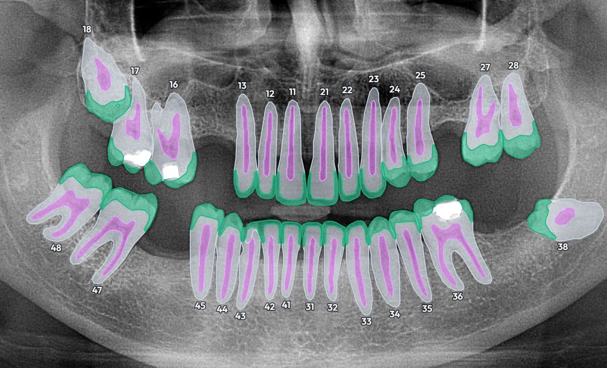 StomaX numbering every tooth and outlining enamel, pulp and dentine