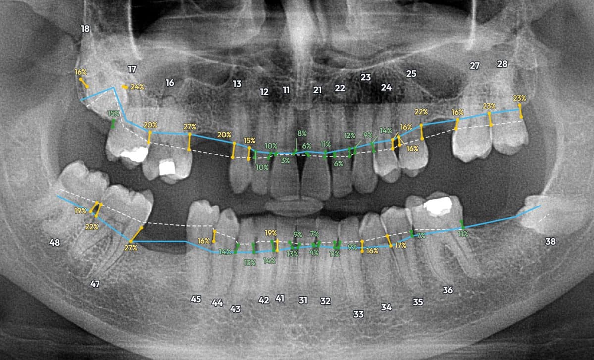 StomaX measuring bone loss at 41 tooth sites, coloured by stage