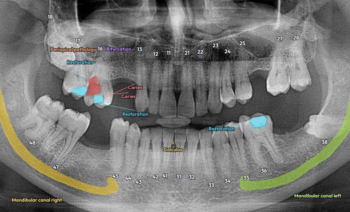 StomaX marking caries, a periapical lesion, restorations and both mandibular canals