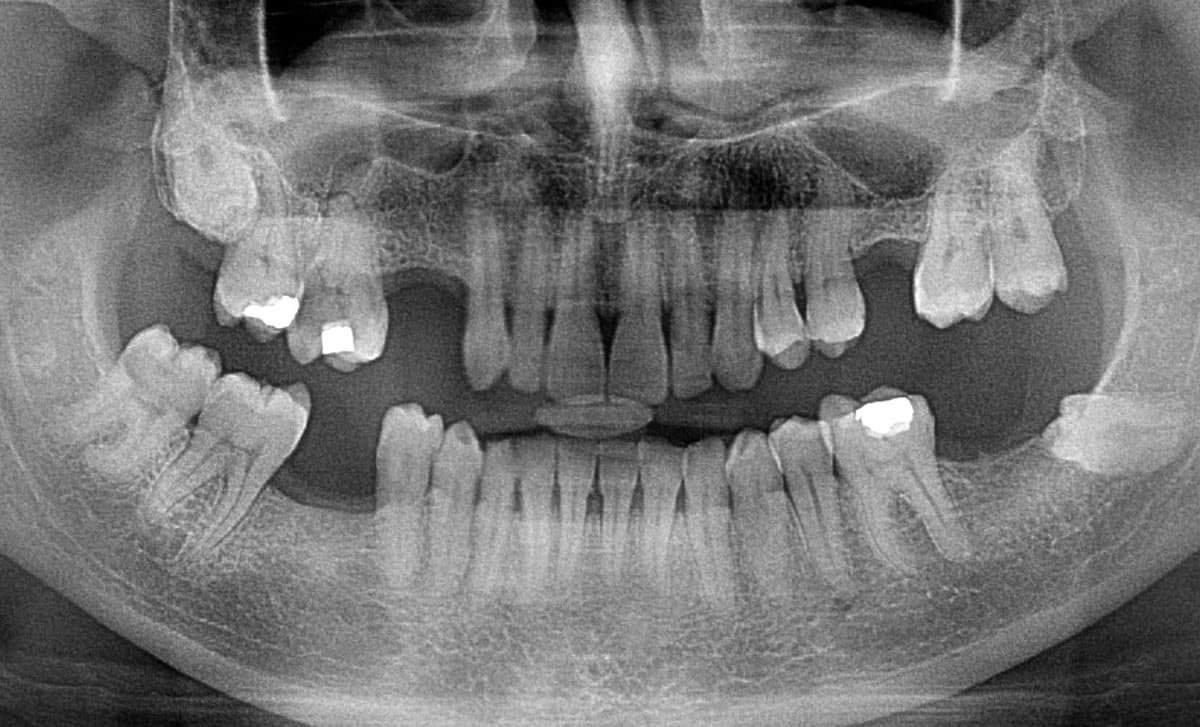 Panoramic X-ray as uploaded